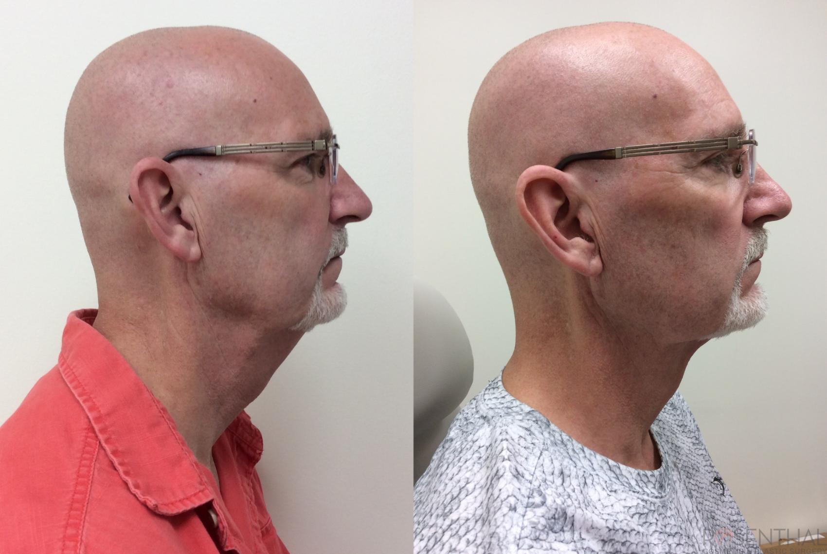 Before & After Facelift Case 15 Right Side View in Boynton Beach, West Palm Beach, FL
