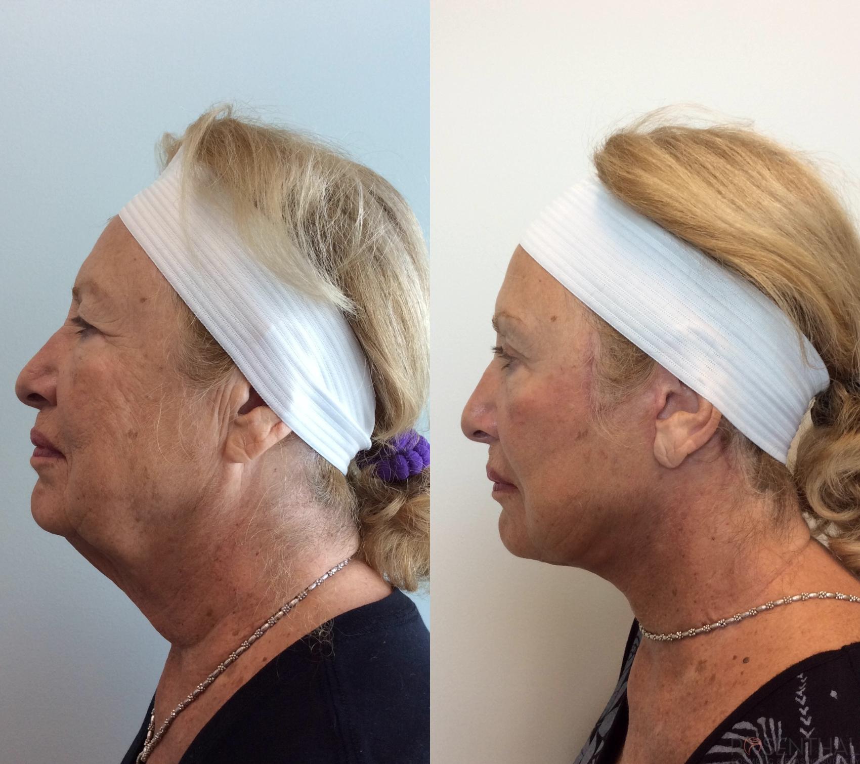 Before & After Facelift Case 16 Right Side View in Boynton Beach, West Palm Beach, FL