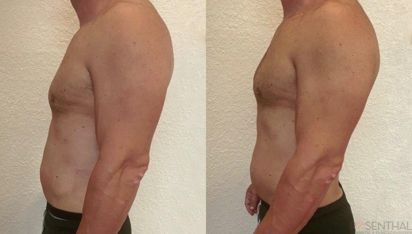 Before & After PHYSIQ Body Contouring Case 3 Left Side View in Boynton Beach, West Palm Beach, FL