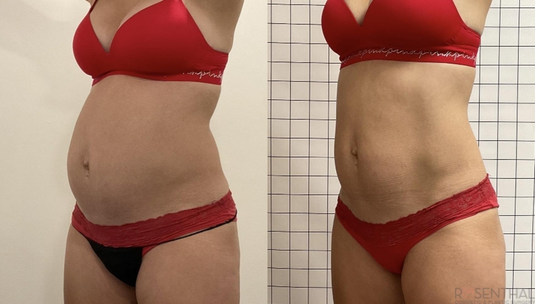 Before & After PHYSIQ Body Contouring Case 4 Left Oblique View in Boynton Beach, West Palm Beach, FL