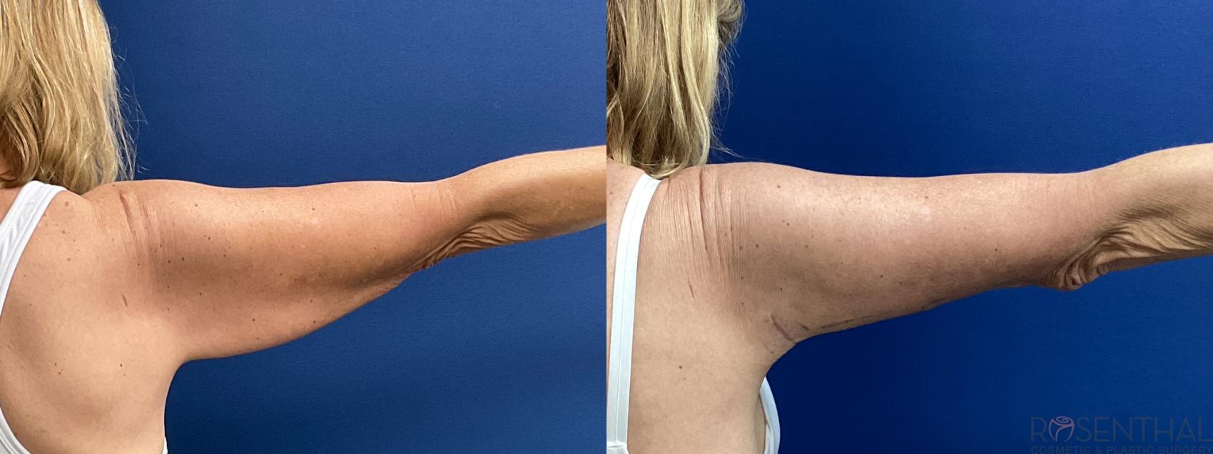 Before & After Arm Lift Case 25 Back View in Boynton Beach, FL