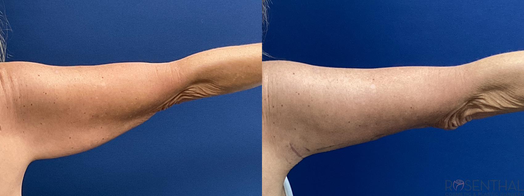 Before & After Arm Lift Case 25 Back View in Boynton Beach, FL