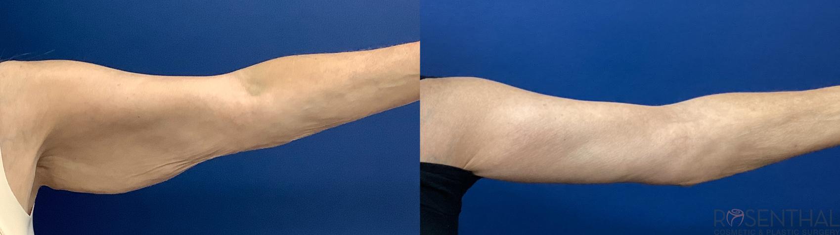 Before & After Arm Lift Case 83 Left Side View in Boynton Beach, West Palm Beach, FL