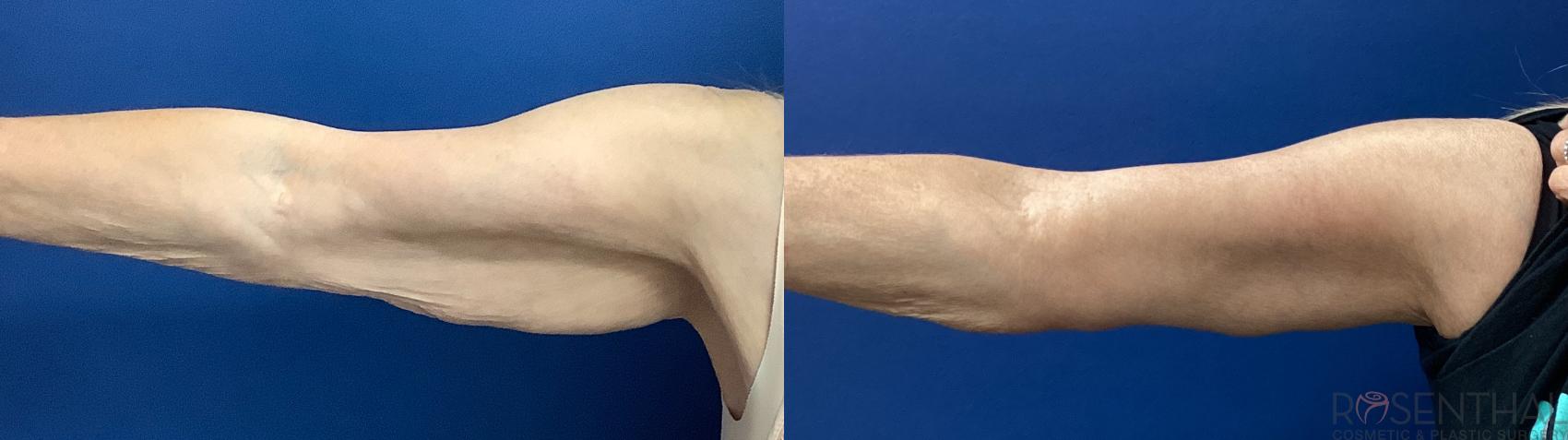 Before & After Arm Lift Case 83 Right Side View in Boynton Beach, West Palm Beach, FL