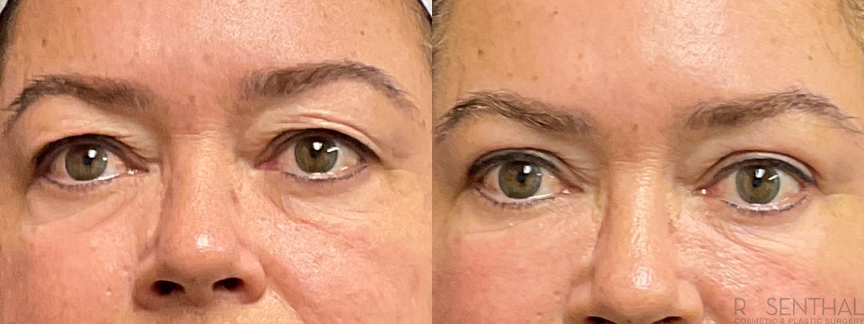 Before & After Blepharoplasty Case 41 Front View in Boynton Beach, West Palm Beach, FL