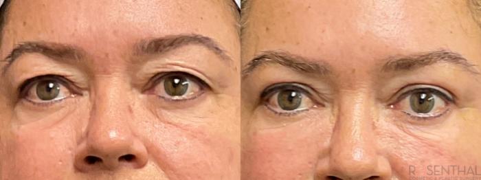 Before & After Blepharoplasty Case 41 Front View in Boynton Beach, West Palm Beach, FL