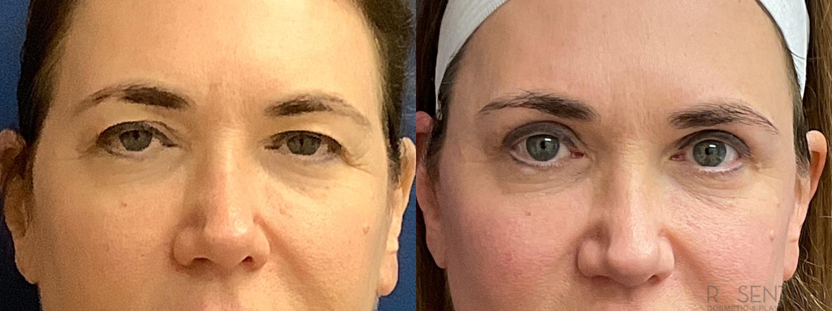 Before & After Blepharoplasty Case 42 Front View in Boynton Beach, West Palm Beach, FL