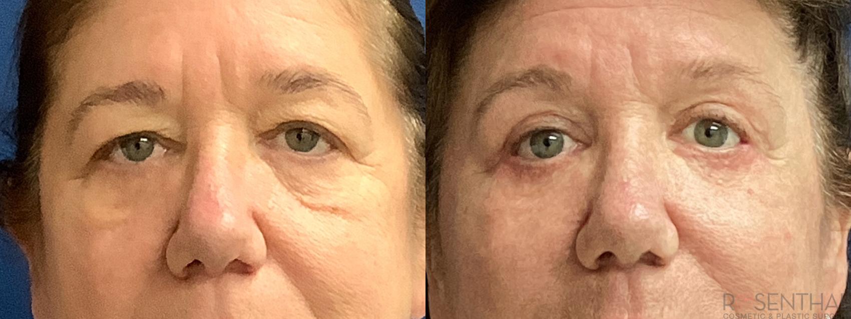 Before & After Blepharoplasty Case 43 Front View in Boynton Beach, West Palm Beach, FL