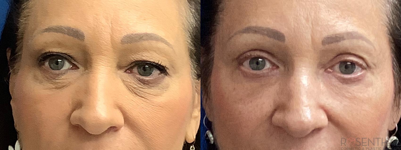 Before & After Blepharoplasty Case 44 Front View in Boynton Beach, West Palm Beach, FL