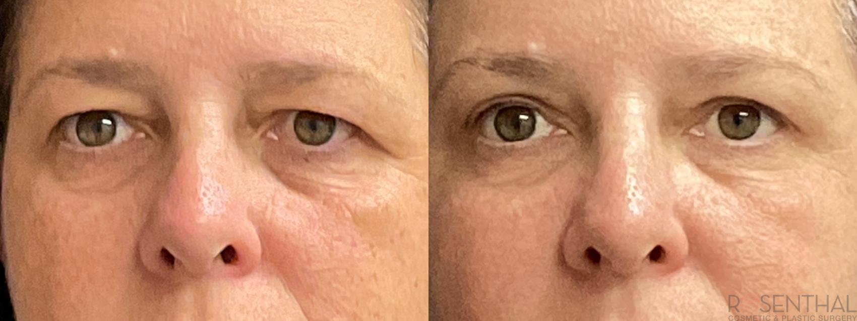 Before & After Blepharoplasty Case 45 Front View in Boynton Beach, West Palm Beach, FL