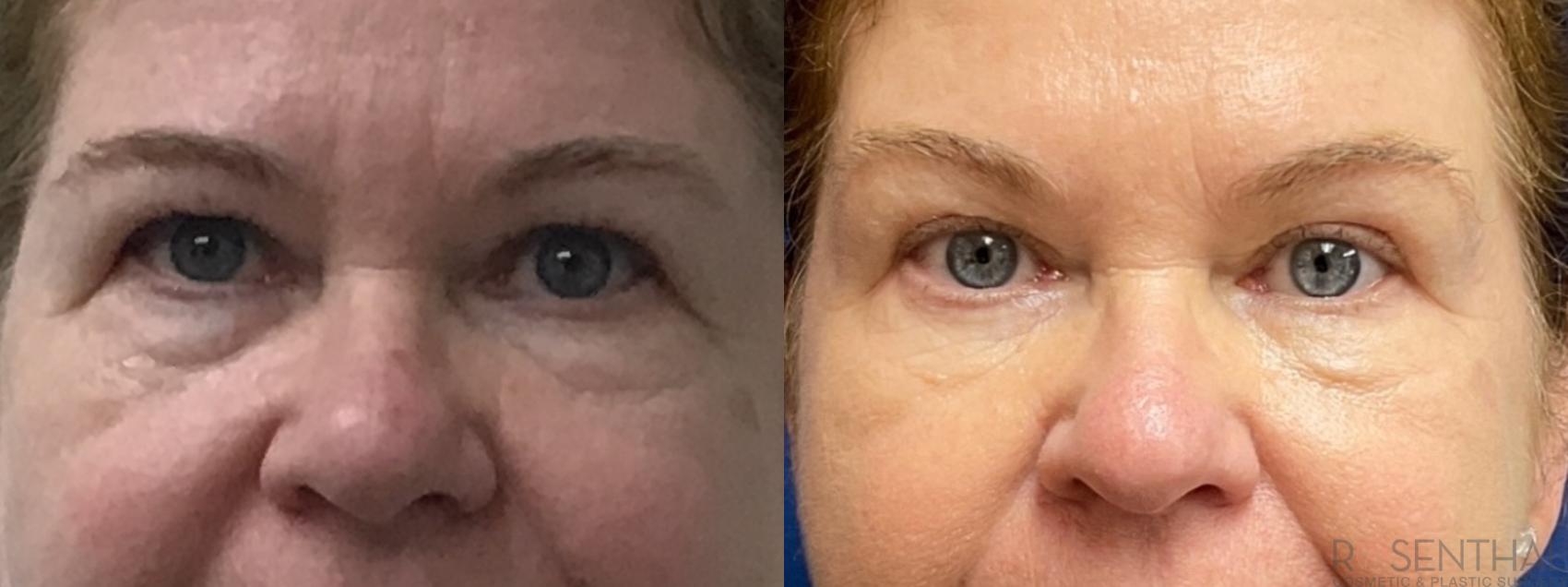 Before & After Blepharoplasty Case 46 Front View in Boynton Beach, West Palm Beach, FL