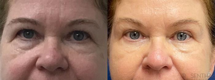 Before & After Blepharoplasty Case 46 Front View in Boynton Beach, West Palm Beach, FL