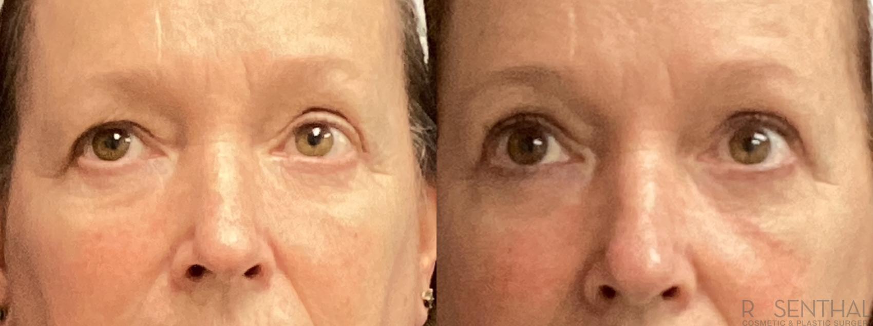 Before & After Blepharoplasty Case 47 Front View in Boynton Beach, West Palm Beach, FL