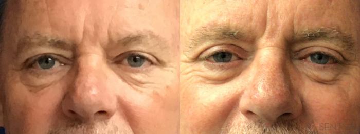 Before & After Blepharoplasty Case 73 Front View in Boynton Beach, West Palm Beach, FL