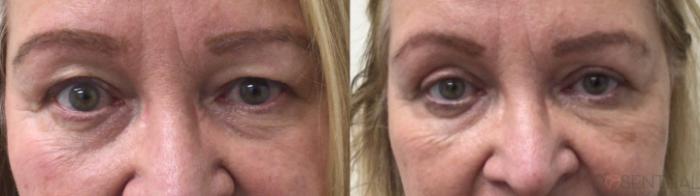 Before & After Blepharoplasty Case 74 Front View in Boynton Beach, West Palm Beach, FL