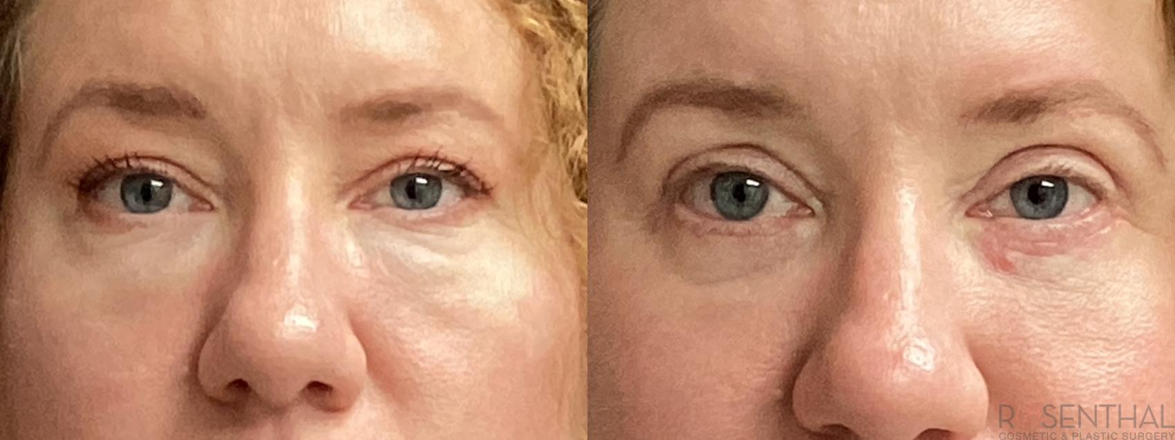 Before & After Blepharoplasty Case 78 Front View in Boynton Beach, West Palm Beach, FL