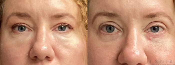 Before & After Blepharoplasty Case 78 Front View in Boynton Beach, West Palm Beach, FL