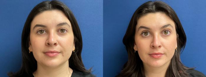 [before and after] [neuromodulator] [brow lift] [face slimming]