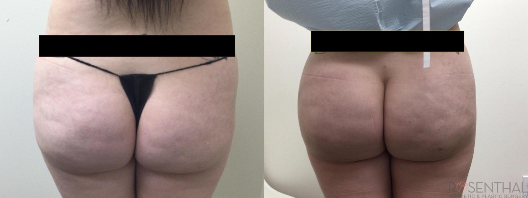 Before & After Brazilian Butt Lift Case 22 Back View in Boynton Beach, West Palm Beach, FL