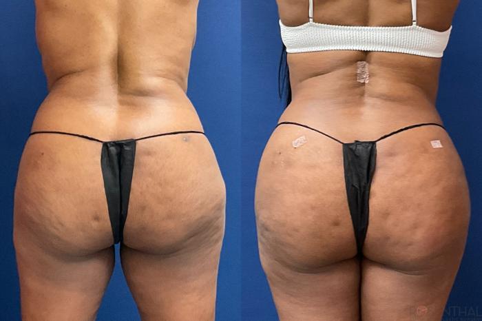 Before & After Brazilian Butt Lift Case 59 Back View in Boynton Beach, West Palm Beach, FL