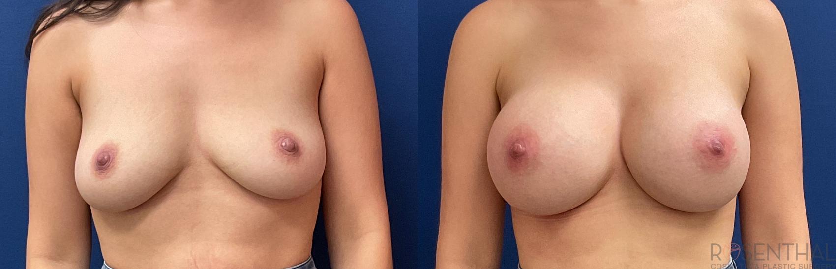 Before & After Breast Augmentation Case 10 Front View in Boynton Beach, FL