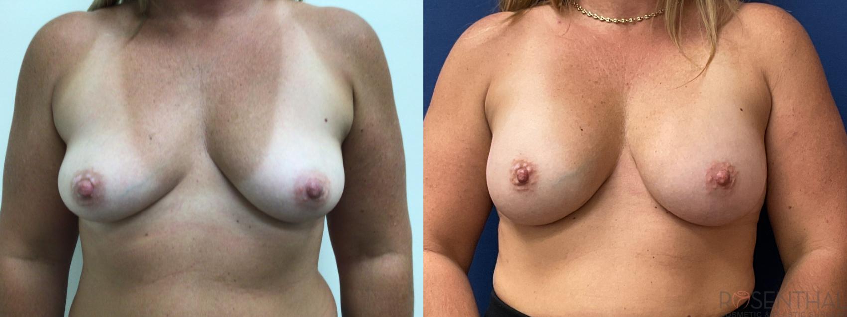 Before & After Breast Augmentation Case 48 Front View in Boynton Beach, West Palm Beach, FL