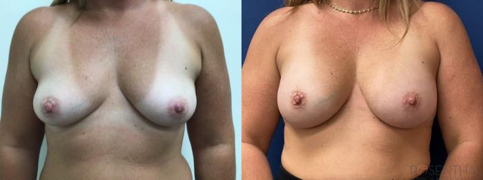 Before & After Breast Augmentation Case 48 Front View in Boynton Beach, West Palm Beach, FL