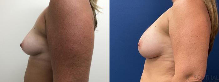 Before & After Breast Augmentation Case 48 Left Side View in Boynton Beach, West Palm Beach, FL