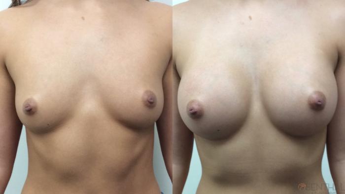 Before & After Breast Augmentation Case 64 Front View in Boynton Beach, West Palm Beach, FL