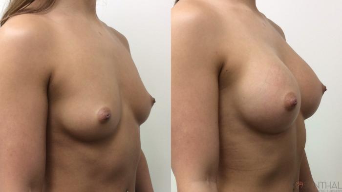 Before & After Breast Augmentation Case 64 Right Oblique View in Boynton Beach, West Palm Beach, FL