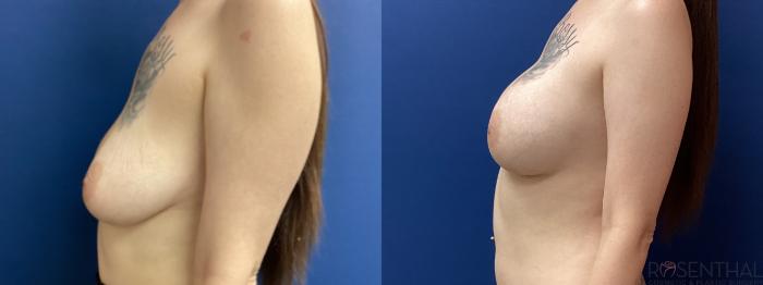 Before & After Breast Augmentation Case 66 Left Side View in Boynton Beach, West Palm Beach, FL