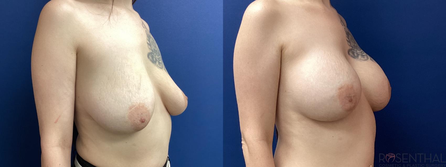 Before & After Breast Augmentation Case 66 Right Oblique View in Boynton Beach, West Palm Beach, FL