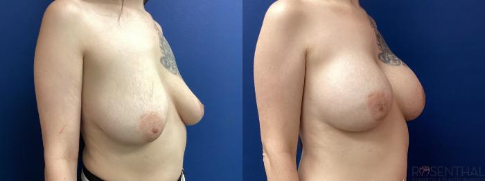 Before & After Breast Augmentation Case 66 Right Oblique View in Boynton Beach, West Palm Beach, FL