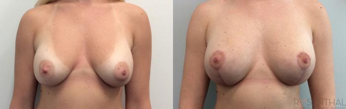 Before & After Breast Augmentation Case 7 Front View in Boynton Beach, FL
