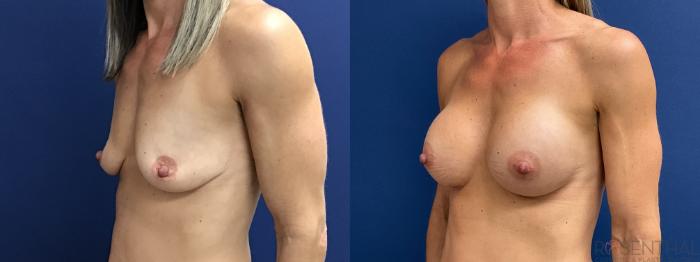 Before & After Breast Augmentation Case 71 Left Oblique View in Boynton Beach, West Palm Beach, FL