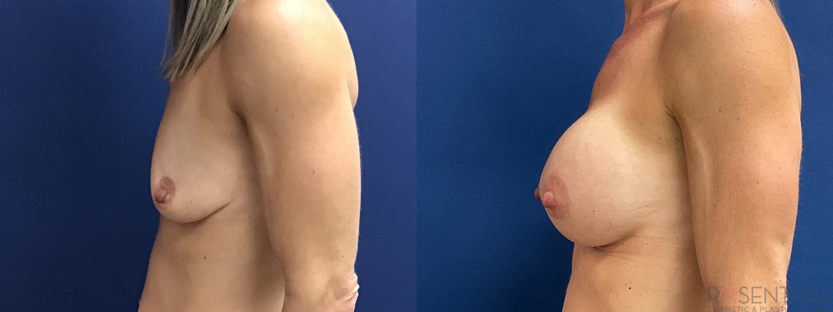 Before & After Breast Augmentation Case 71 Left Side View in Boynton Beach, West Palm Beach, FL