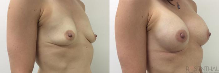 Before & After Breast Augmentation Case 8 Left Oblique View in Boynton Beach, FL