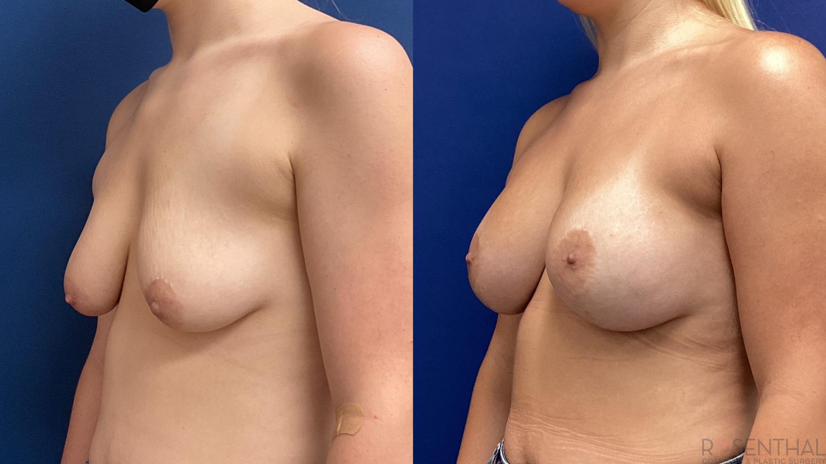 Before & After Breast Augmentation Case 80 Left Oblique View in Boynton Beach, West Palm Beach, FL