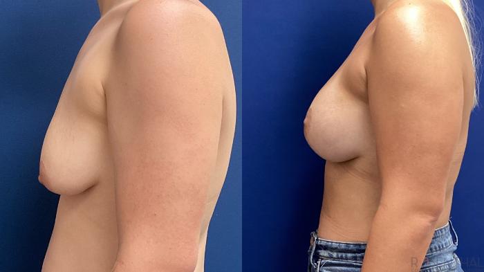 Before & After Breast Augmentation Case 80 Left Side View in Boynton Beach, West Palm Beach, FL