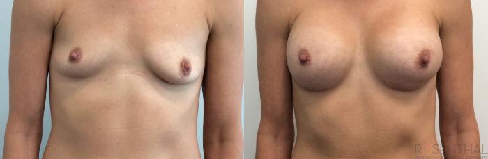 Before & After Breast Augmentation Case 9 Front View in Boynton Beach, FL