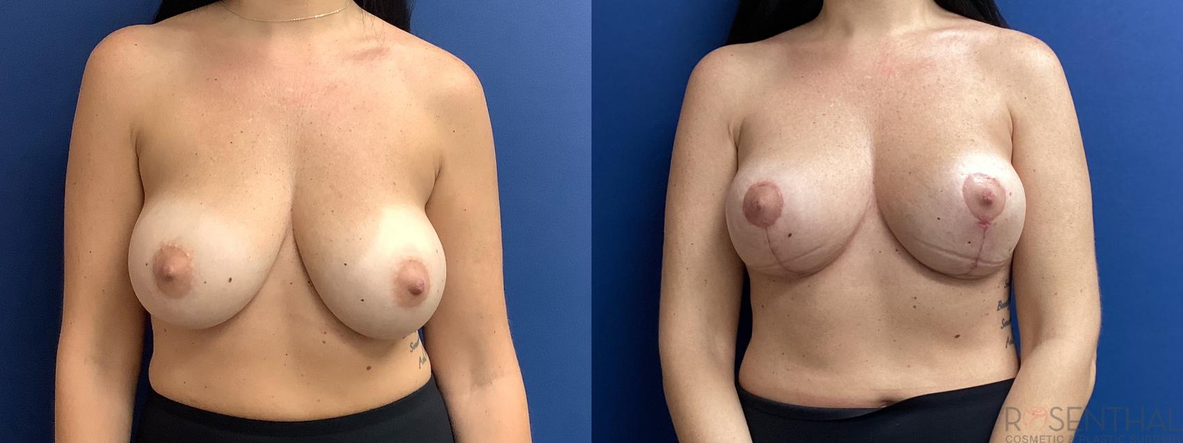 Before & After Breast Lift Case 28 Front View in Boynton Beach, West Palm Beach, FL