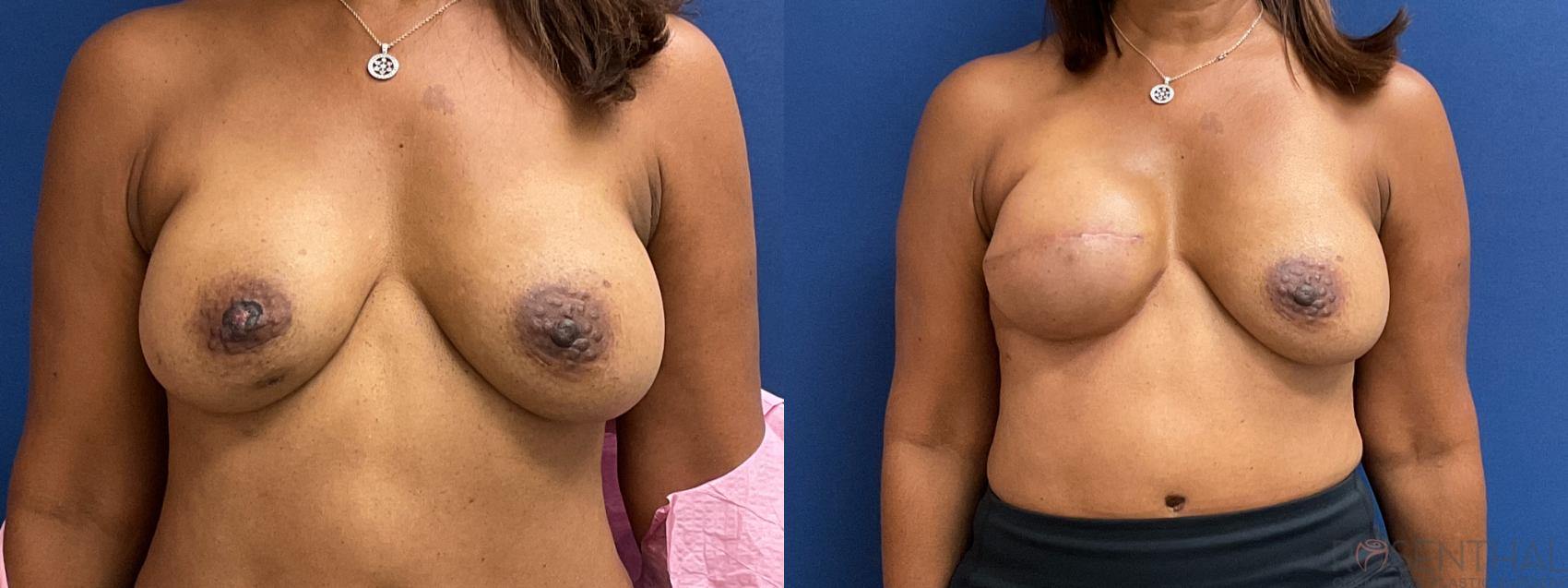 Before & After Breast Reconstruction Case 24 Front View in Boynton Beach, FL