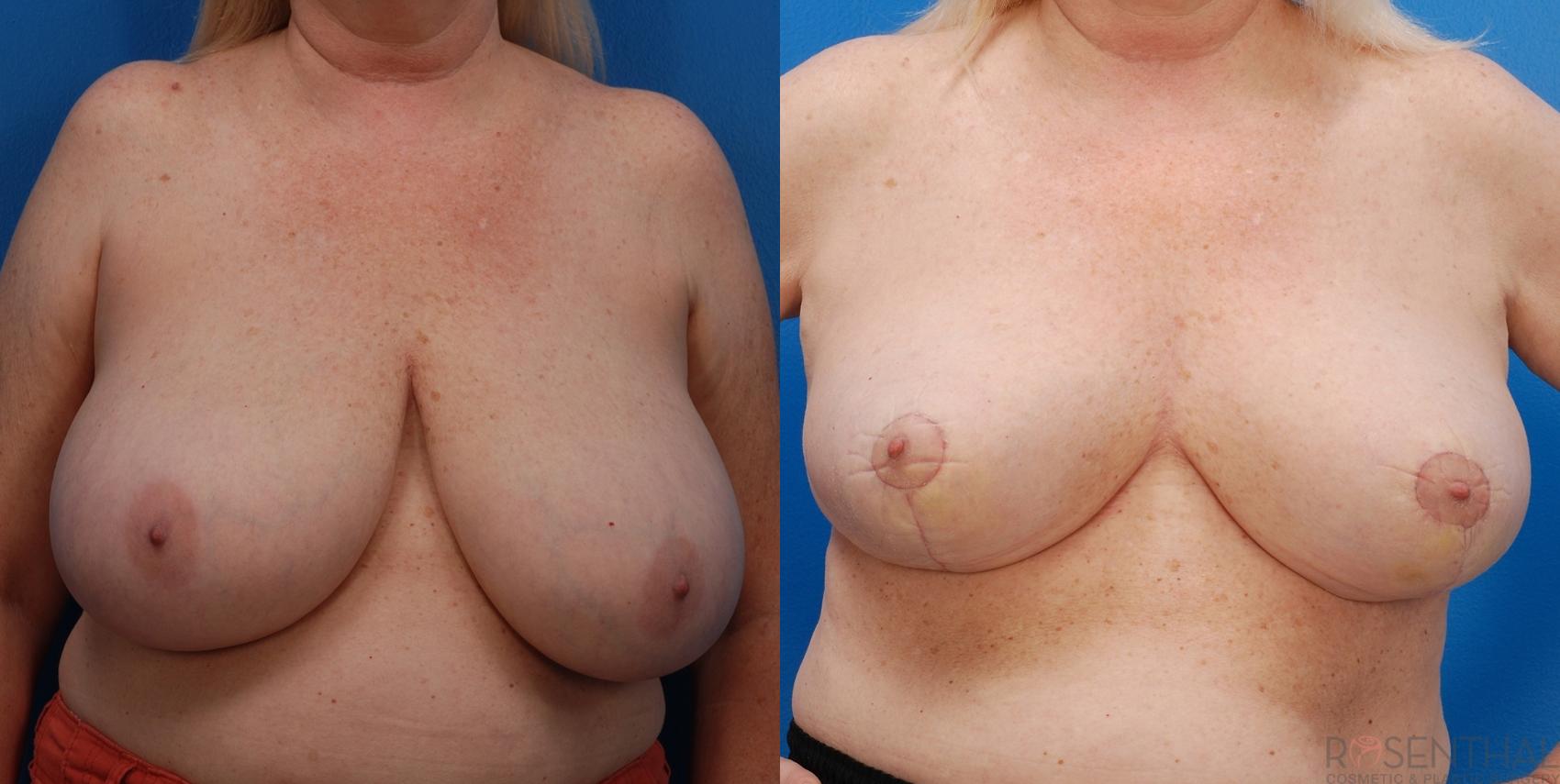 Before & After Breast Reduction Case 19 Front View in Boynton Beach, FL