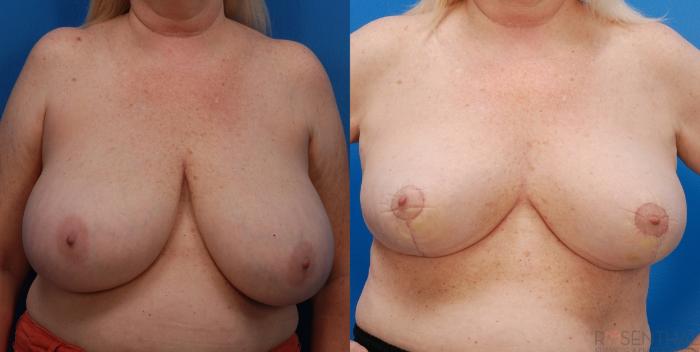 Before & After Breast Reduction Case 19 Front View in Boynton Beach, FL
