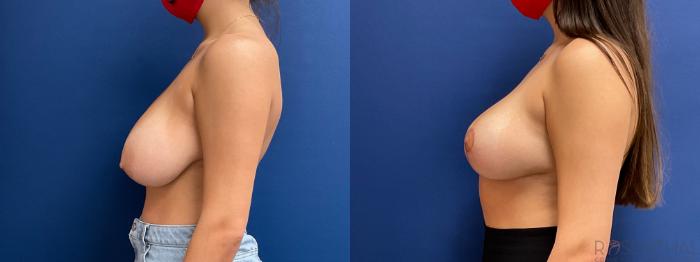 Before & After Breast Reduction Case 20 Right Side View in Boynton Beach, FL