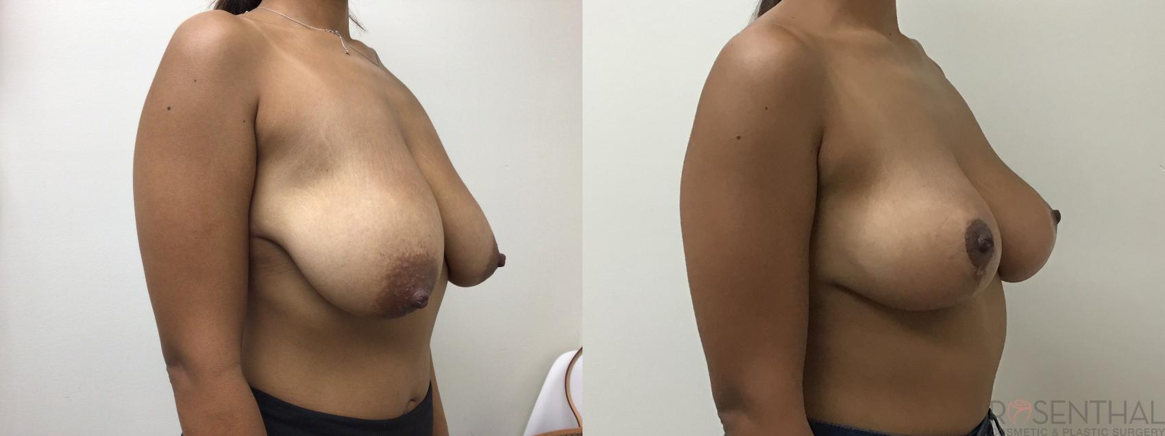 Before & After Breast Reduction Case 21 Left Oblique View in Boynton Beach, FL