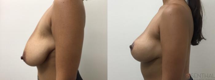 Before & After Breast Reduction Case 21 Left Side View in Boynton Beach, West Palm Beach, FL