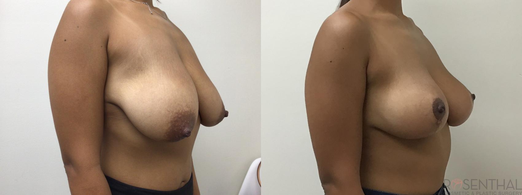 Before & After Breast Reduction Case 21 Right Oblique View in Boynton Beach, West Palm Beach, FL