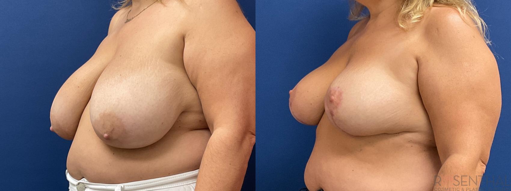 Before & After Breast Reduction Case 50 Left Oblique View in Boynton Beach, West Palm Beach, FL