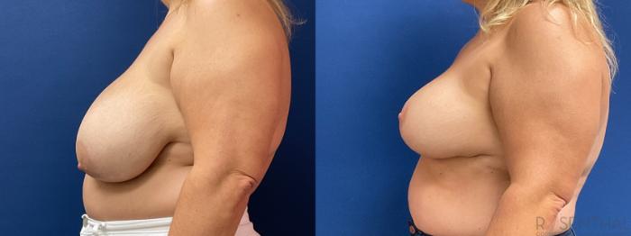 Before & After Breast Reduction Case 50 Left Side View in Boynton Beach, West Palm Beach, FL